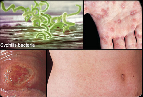 Khiếp đảm những hình ảnh bệnh lây qua đường tình dục - ảnh 2