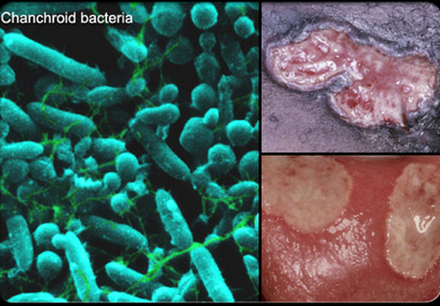 Khiếp đảm những hình ảnh bệnh lây qua đường tình dục - ảnh 4