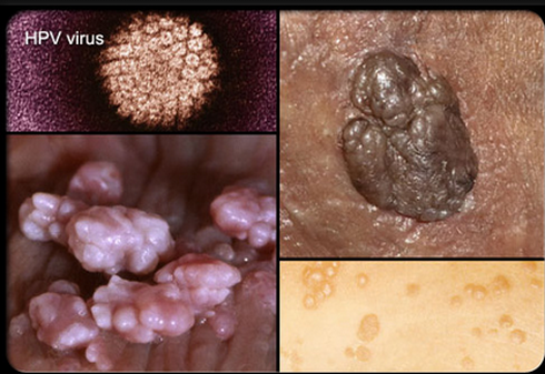 Khiếp đảm những hình ảnh bệnh lây qua đường tình dục - ảnh 3