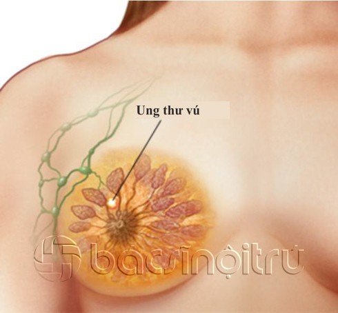 Chi tiết các giai đoạn của ung thư vú - ảnh 2