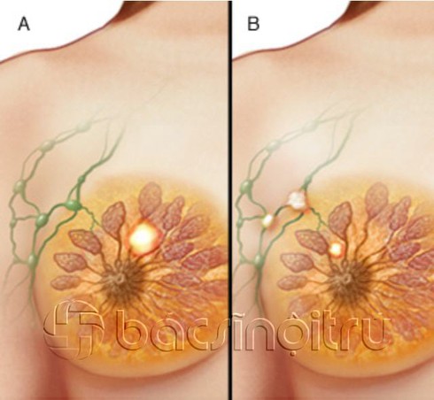 Chi tiết các giai đoạn của ung thư vú - ảnh 3