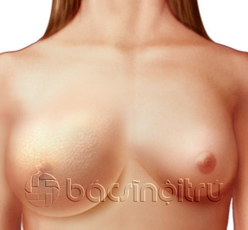 Chi tiết các giai đoạn của ung thư vú - ảnh 1