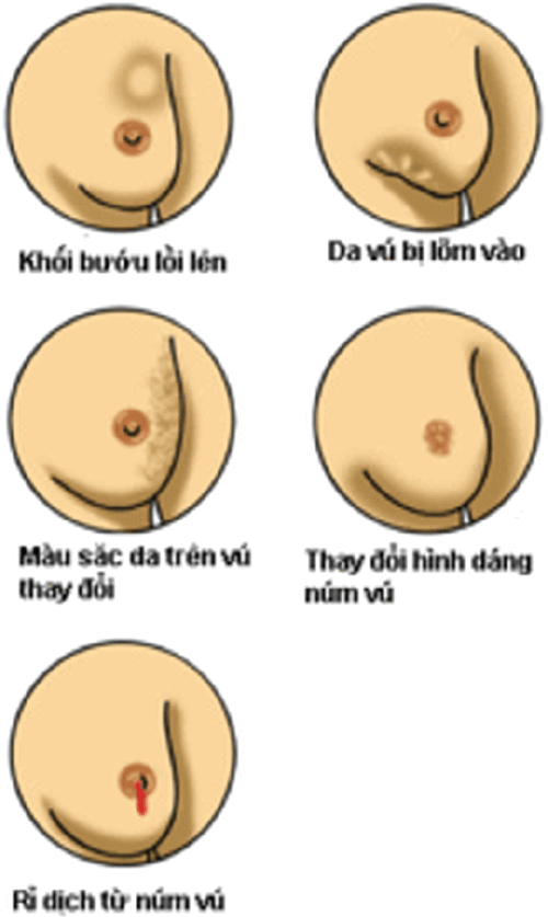 Chi tiết các giai đoạn của ung thư vú - ảnh 6