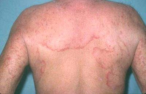 Bệnh nấm da thường gặp và cách chữa trị - ảnh 1