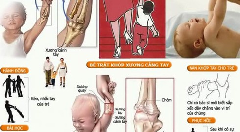 Các dấu hiệu nhận biết sai khớp - ảnh 1