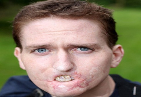 Mất cặp môi và tứ chi do vi khuẩn ăn thịt - ảnh 1