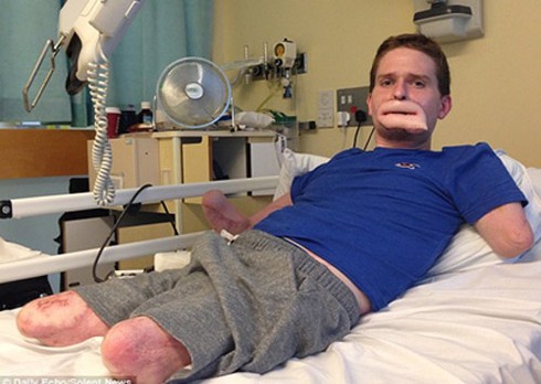 Mất cặp môi và tứ chi do vi khuẩn ăn thịt - ảnh 2