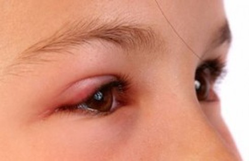 Cách chữa đau mắt đỏ nhanh nhất - ảnh 1