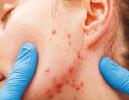 Nguy hiểm khôn lường trong một số loại kem trị mụn - ảnh 1
