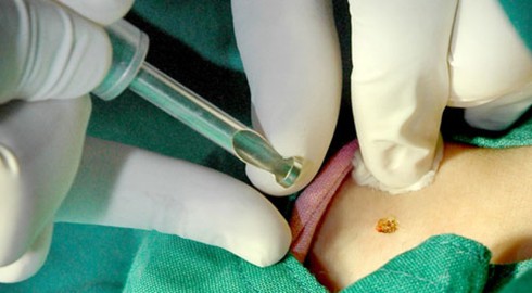 Điều trị mụn cóc: Lựa chọn phương pháp hợp lý - ảnh 1