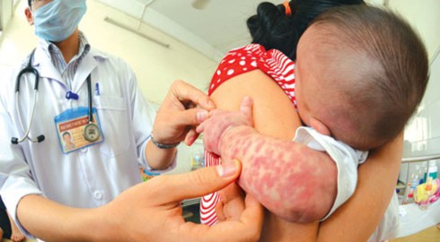 Phát hiện ổ dịch nghi bệnh sởi trên 49 trẻ - ảnh 1