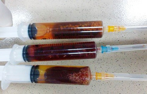 Sán chui vào tim do ăn đồ sống - ảnh 1