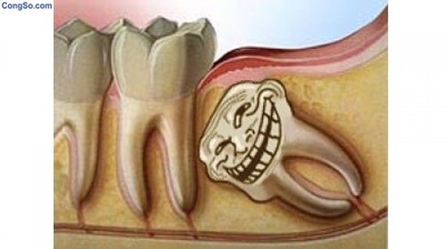 Vì sao phần lớn răng khôn phải nhổ bỏ? - ảnh 1