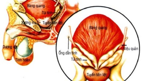 Bệnh tuyến tiền liệt – chớ coi thường! - ảnh 1