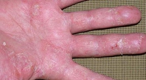 Dấu hiệu nhận biết bệnh tổ địa - ảnh 1