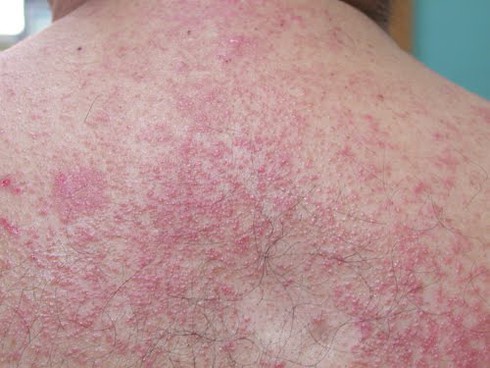 8 cách đánh bay rôm sảy - ảnh 1