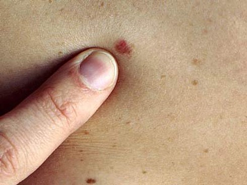 Dấu hiệu bất thường nào ở da cảnh báo ung thư? - ảnh 1