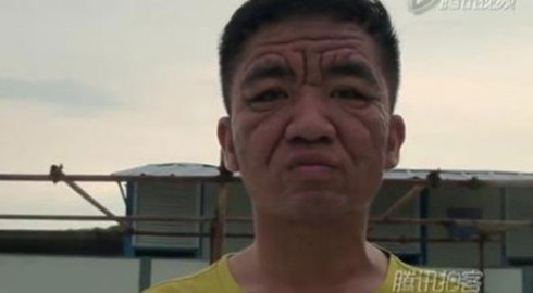 Bệnh lạ khiến chàng trai 30 tuổi già như ông cụ - ảnh 1