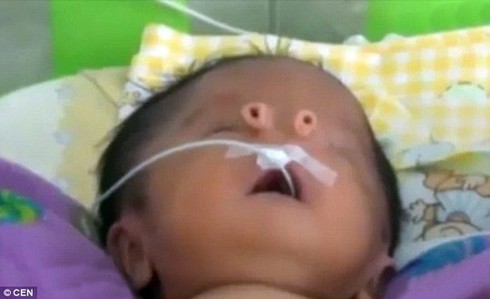 Bé sơ sinh có lỗ mũi như chiếc ống nhỏ - ảnh 1