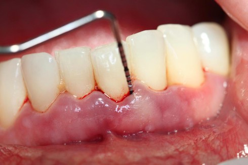 Truy tìm nguyên nhân chảy máu chân răng - ảnh 1