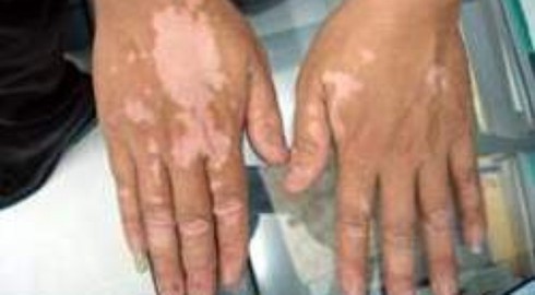 Bệnh bạch biến và một số thuốc điều trị - ảnh 1