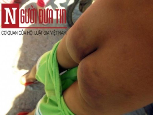 Cô giáo đánh bầm dập 12/24 học sinh, phụ huynh đến trường phản đối - ảnh 1