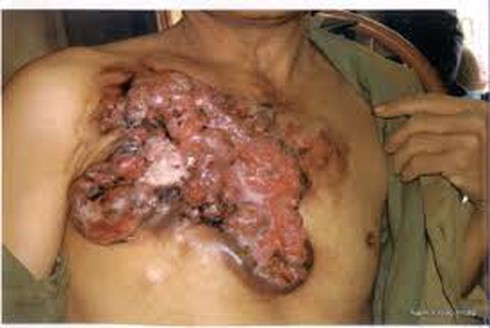 Những dấu hiệu cảnh báo bạn đã mắc ung thư giai đoạn đầu - ảnh 1