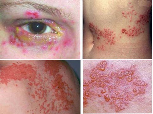 Cách chữa zona thần kinh thế nào cho đúng? - ảnh 1