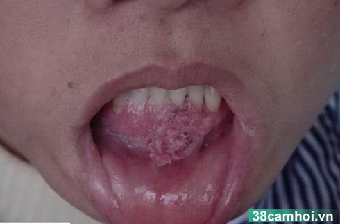 Sợ hãi khi phát hiện bạn tình mắc sùi mào gà - ảnh 1