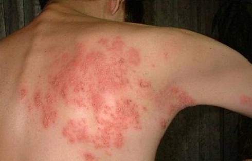 Ai dễ mắc bệnh zona thần kinh? - ảnh 1