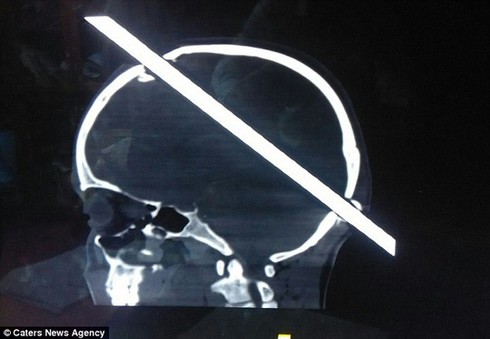 Bị thanh sắt 2 m đâm xuyên đầu vẫn sống khỏe - ảnh 2