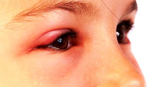 Mắt lên chắp nhiều lần, làm sao không bị tái phát? - ảnh 1
