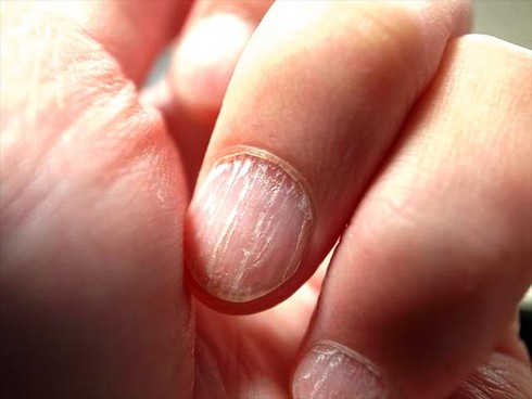 Màu sắc móng tay báo hiệu bệnh gì? - ảnh 1