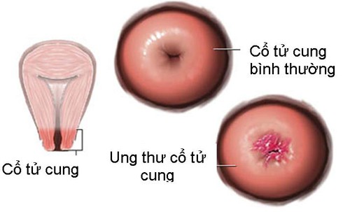 Ung thư cổ tử cung - Những điều cần biết - ảnh 1