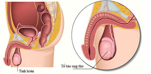 Dấu hiệu ung thư tinh hoàn - ảnh 1