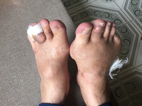 Bài thuốc gia truyền điều chỉnh axit uric do bệnh gout - ảnh 2