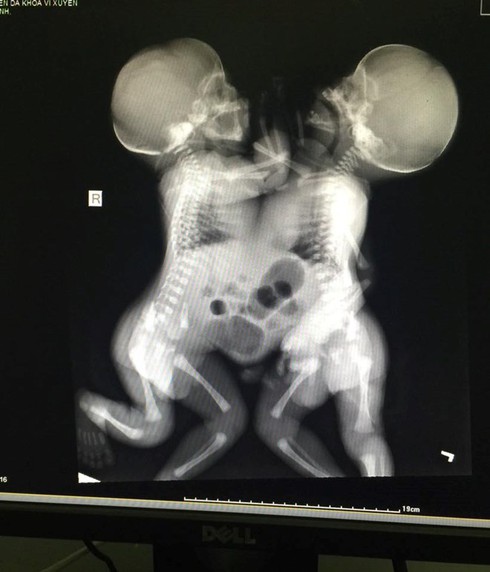 Sức khỏe 2 bé sơ sinh dính liền nhau ở Hà Giang diễn biến xấu - ảnh 1