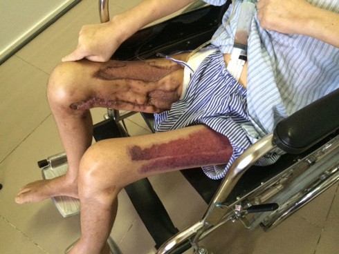 Hoại tử toàn thân do... tiêm thuốc đau lưng tùy tiện - ảnh 1