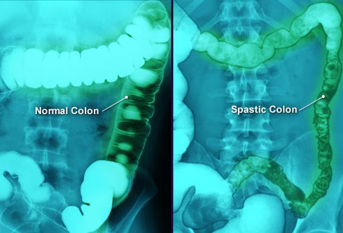 Những nguyên nhân hàng đầu gây đau bụng dưới ở phụ nữ - ảnh 3