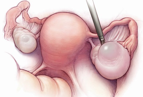 Những nguyên nhân hàng đầu gây đau bụng dưới ở phụ nữ - ảnh 2