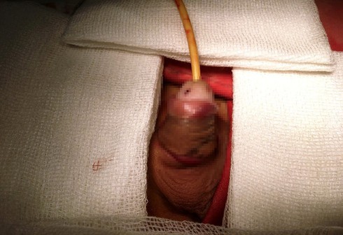 Nối thành công dương vật bị đứt lìa do kẹt vào miếng gỗ - ảnh 1