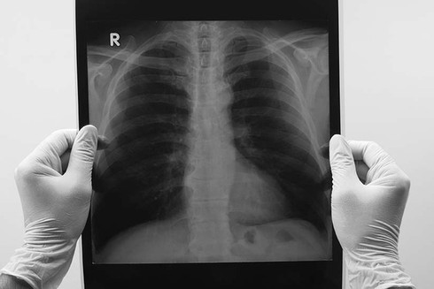 Vì sao không hút thuốc vẫn bị ung thư phổi? - ảnh 1