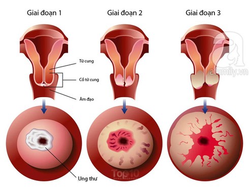 Dấu hiệu ung thư cổ tử cung chị em cần biết - ảnh 1