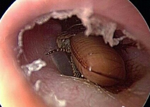 Tự xịt thuốc diệt côn trùng vào lỗ tai để giết gián - ảnh 1