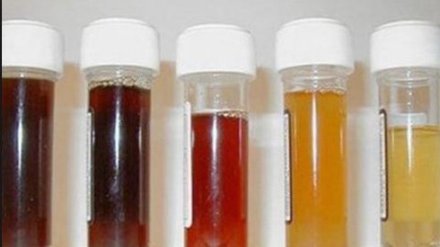 Nguyên nhân tiểu ra máu là gì? - ảnh 1