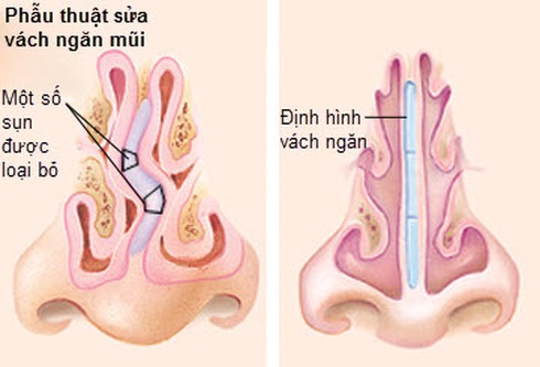 Có thể điều trị khỏi viêm mũi dị ứng và lệch vách ngăn mũi không? - ảnh 1