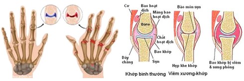 Viêm khớp dạng thấp có chữa khỏi được không? - ảnh 1
