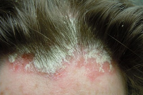 Trị viêm chân tóc, tránh rụng tóc - ảnh 1