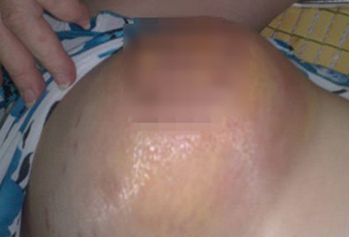 Gánh họa vì nâng ngực bằng silicon lỏng