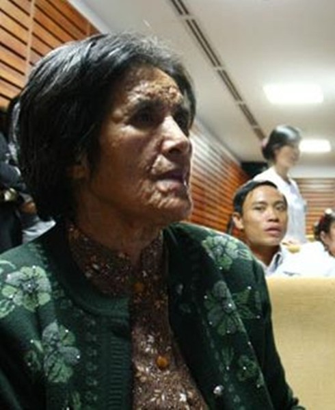 Phẫu thuật khối u khổng lồ: 8 tiếng tách được 1/3